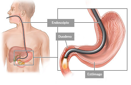 Endoscopia: o que é, como é feito e cuidados necessários