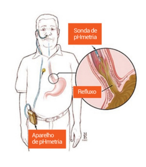 Phmetria esofágica prolongada