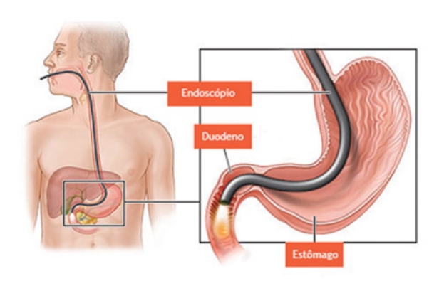 Endoscopia Digestiva Alta